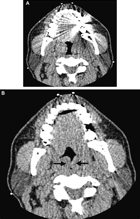 Complete Obstruction Related To Enlarged Palatine Tonsils Arrows