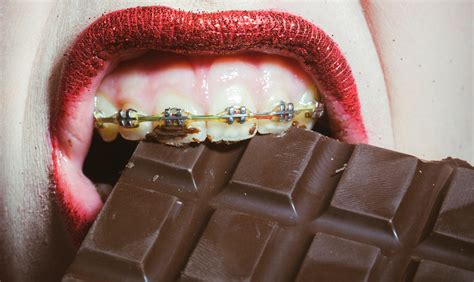 Eating With Braces Alternatives To Foods You Cant Eat Orthodontists