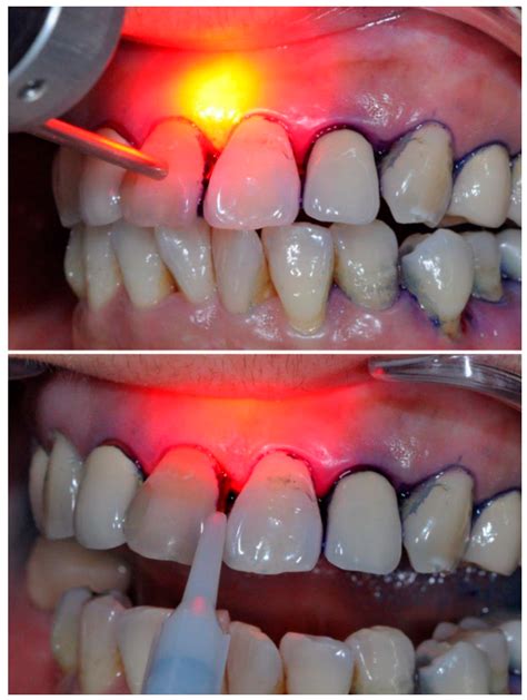 Ijms Free Full Text Photonic Therapy In Periodontal Diseases An
