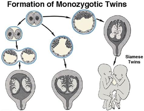 Monozygotic Twins Ob Nursing Getting Things Done Nursing School