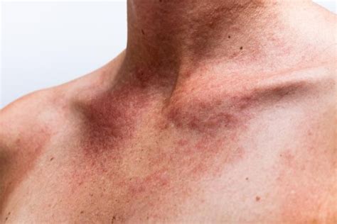 Sun Poisoning Rash Lovetoknow Heat Rash Sun Poisoning Rash Skin