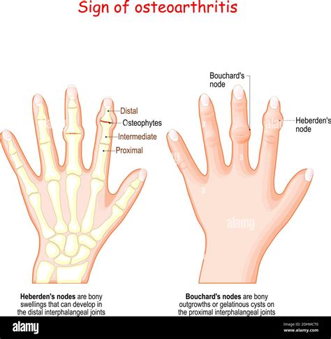 Sign Of Osteoarthritis Human Hand With Heberdens Node And Bouchards