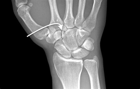 Trapezoid Fracture Hand Surgery Source