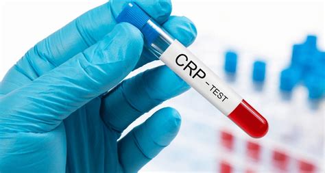 High Sensitivity CRP Test - Preparation, Procedure And Risks
