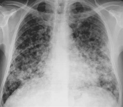 Стол диета при туберкулезе Стол при туберкулезе легких - 90 фото Стол при туберкулезе легких - 90 фото Стол диета при туберкулезе