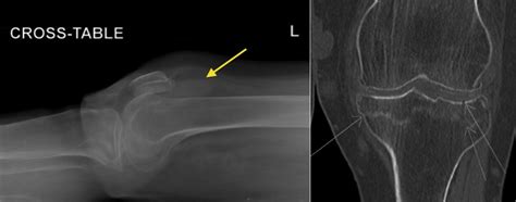 Lipohaemarthrosis Of The Knee Radiology At St Vincents University