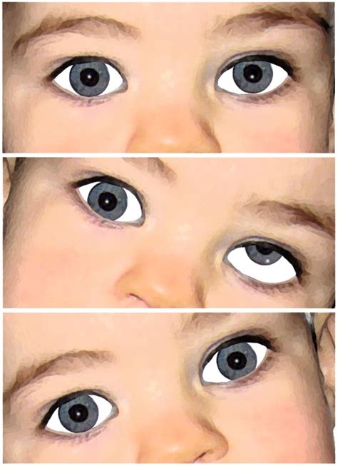 Congenital Paralysis Of The Superior Oblique Athens Eye Hospital