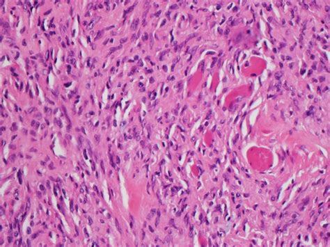 Pathology Outlines Low Grade Myofibroblastic Sarcoma