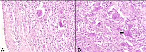 Rhizopus are the most common species, with rhizomucor, cunninghamella, saksenaea, and apophysomyces species. . Histo-pathological micrographs. The histopathology ...