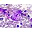 Jenner Giemsa Stained Bone Marrow Smear Showing Histiocyte Containing 
