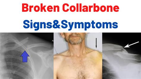 Broken Collarbone Clavicle Bone Fracture Causes Symptoms Treatment