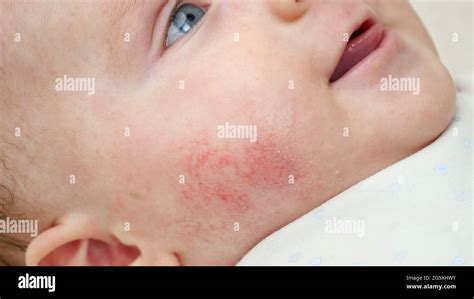 Closeup Of Baby Face Skin With Pimples And Acne From Dermatitis