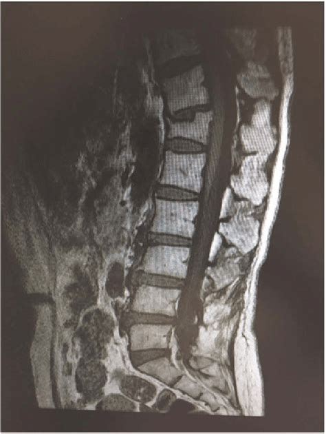 Lumbar Spine Mri T Weighted Image Sagittal View No Focal Lesion Was