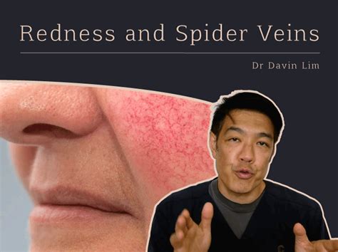 Spider Vein Treatment Brisbane Cutis Dermatology