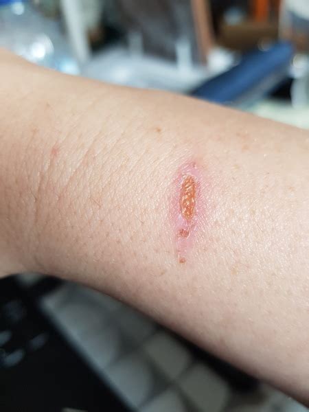 Is My Burn Infected Mumsnet