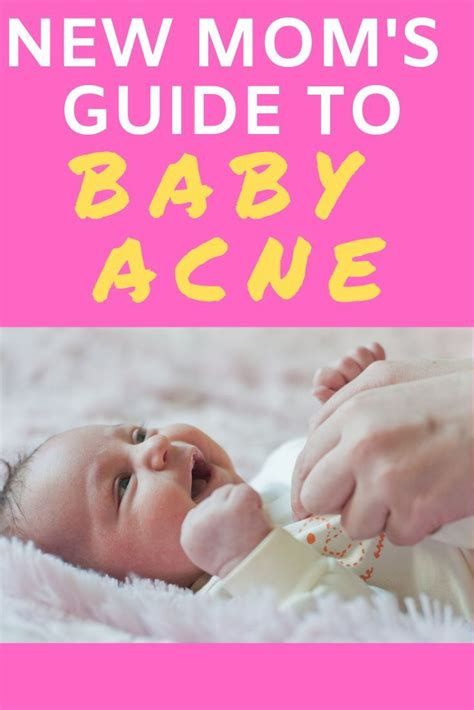 What Causes Baby Acne Simple Ways To Help It Clear Up Baby Acne