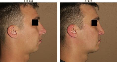 Rhinoplasty Before And After Pictures Dr Turowski Plastic
