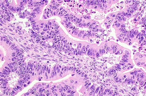 Mucinous Carcinoma Of The Ovary Mypathologyreportca