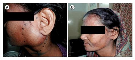 A Left Parotid Swelling Measuring 58×42×4 Cm At Initial Diagnosis