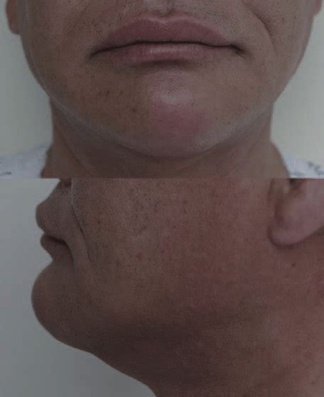 A Protruding Mass Is Visible On The Anterior Chin Of A 60 Year Old