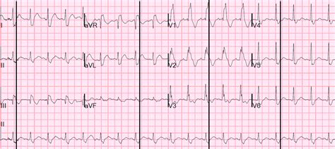 Dr Smiths Ecg Blog Pseudostemi And True St Elevation In Right Bundle