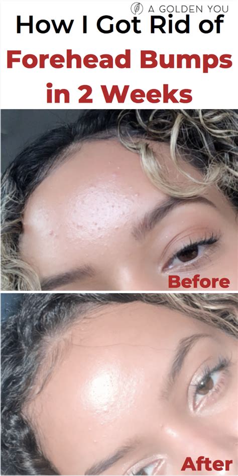 How To Get Rid Of Bumps On Forehead Overnight Surffishinga