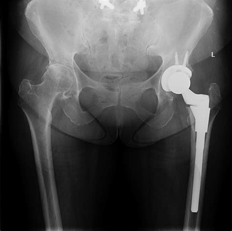 Standing Ap Pelvic Radiograph After Left Total Hip Replacement