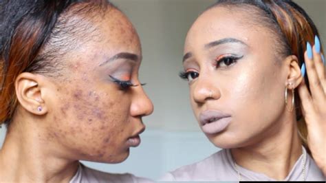 Applying Makeup To Cover Acne Scars Makeupview Co