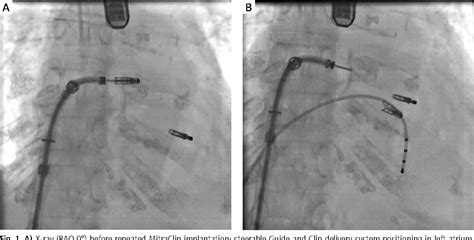 Figure 1 From Simultaneous Transfemoral Transcatheter Mitral And