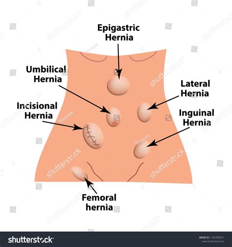Types Hernia Lateral Umbilical Inguinal Femoral Εικονογράφηση μόδας