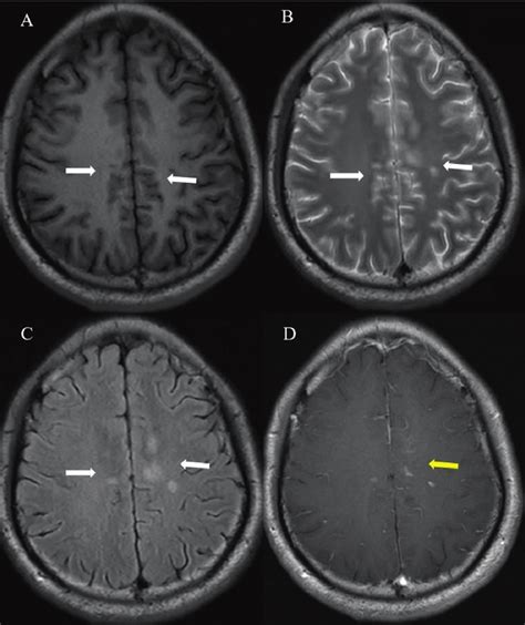 Post Contrast Mri On The 40th Day Axial T1 A T2 B T2 Flair