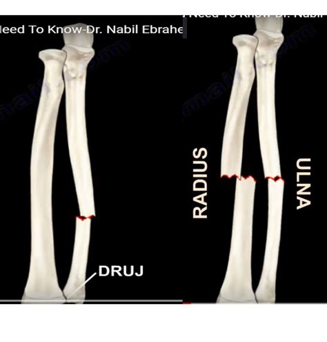 Radius And Ulna Shaft Fractures —