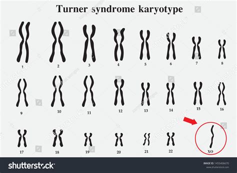 Karyotype Turner Syndrome Ts Known X Stock Vector Royalty Free