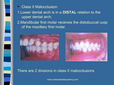 Classification And Etiology Of Malocclusion Ppt