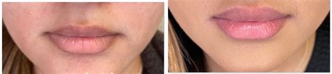 Dermal Fillers By A Greater Houston Tx Dermatologist Dermsurgery Associates