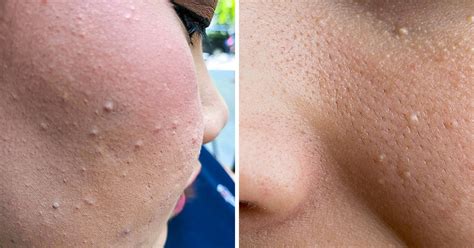 What Those Little White Bumps On Your Skin Are And What To Do About Them Bright Side