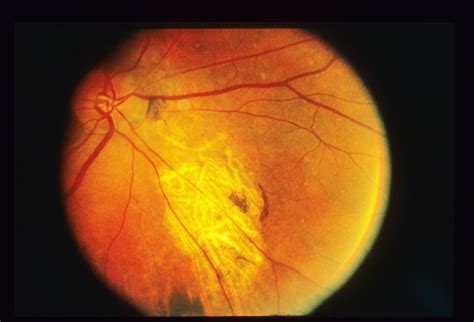 Recurrent Central Serous Retinopathy With Edema Retina Image Bank