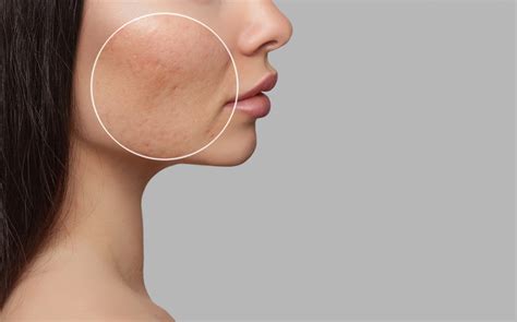 Tips For Treating And Preventing Acne Jersey Shore Medical Alliance Nj