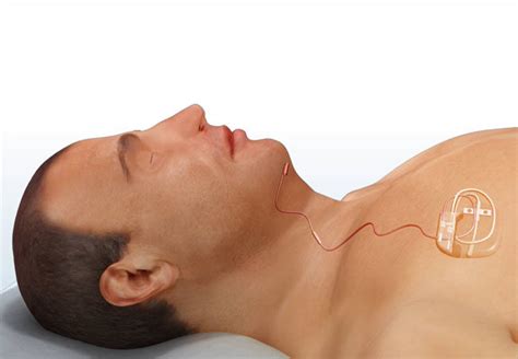 Fda Approves New Surgical Approach For Neurostimulation Device To Treat