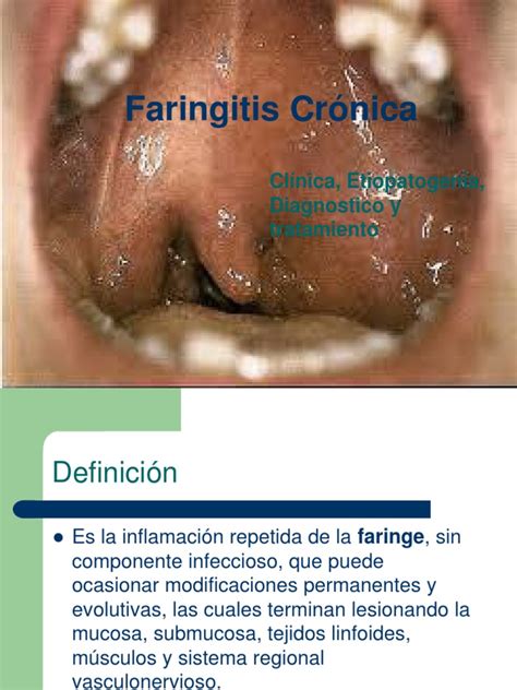 Faringitis Crónica Condicion Cronica La Enfermedad Por Reflujo