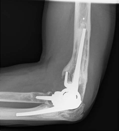 Mid Term Results Of The Latitude Primary Total Elbow Arthroplasty