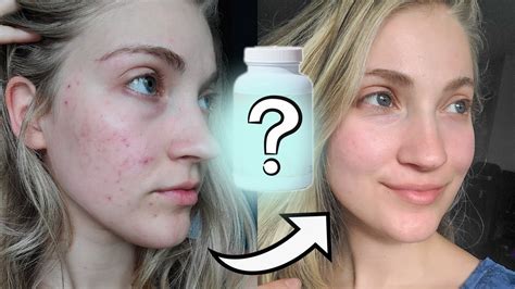 The Supplement That Cleared My Acne And Saved My Skin Youtube