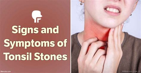 Tonsil Stones Symptoms