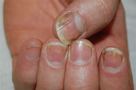 Psoriasis In The Nails Home Interior Design
