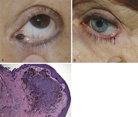 Benign And Premalignant Tumors Of The Eyelid Ento Key