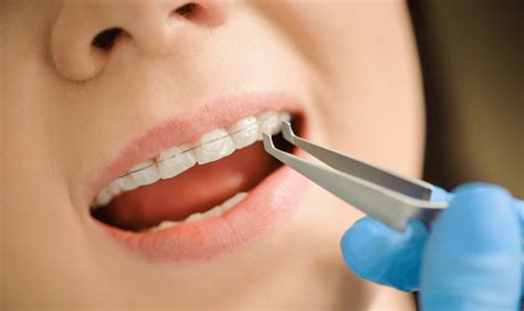 Ceramic Braces Effective Solution For A Beautiful Smile