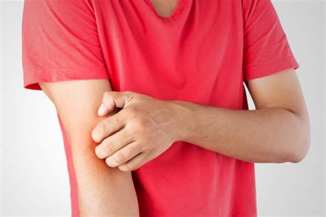 Solar Urticaria Sun Allergy Rash Treatment Symptoms And More