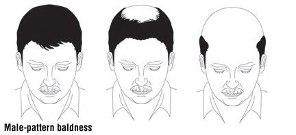 Androgenic alopecia is the most common cause of hair loss in both men and women. Hair Loss Guide: Causes, Symptoms and Treatment Options