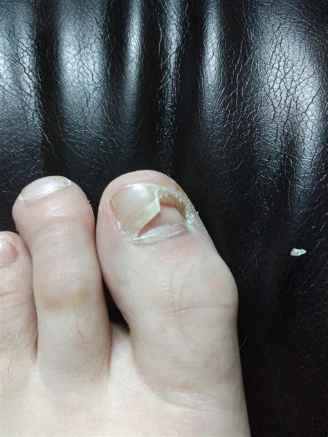 I Have A Toenail Growing Under My Toenail Toe Nails Medical