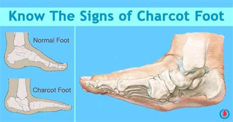 Sur quelques arthropathies qui paraissent dependre d'une lesion du cerveau ou de la moelle epiniere bаnks a. Who is at Risk of Developing Charcot Foot? | Diabetes ...